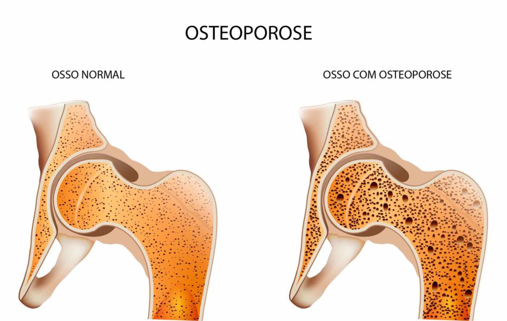 Entenda O Que A Osteoporose E Como Se Prevenir Sa De Vitalidade