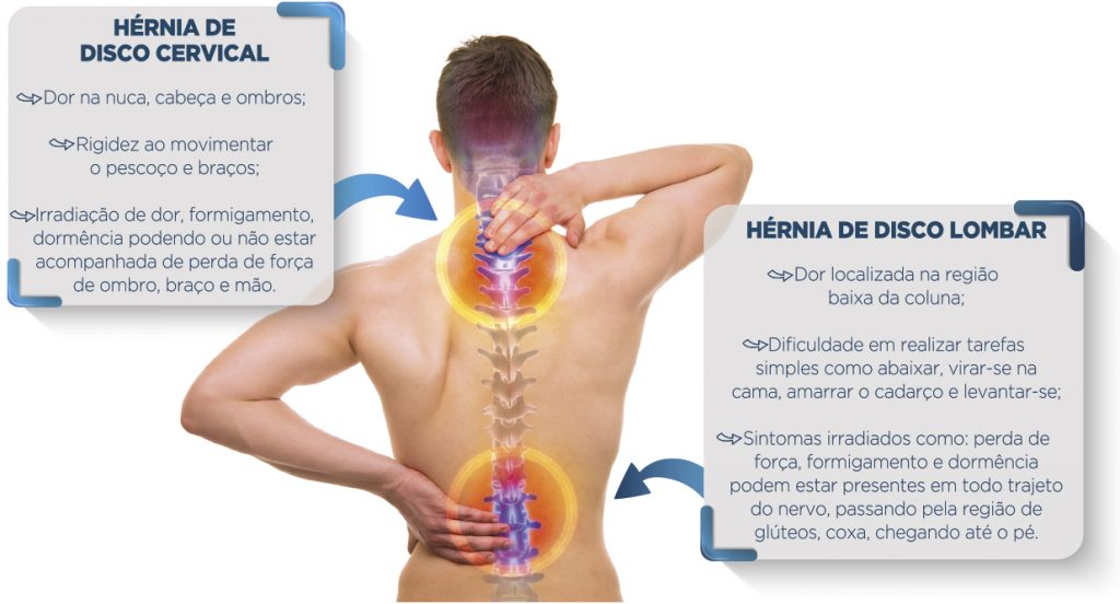 H Rnia De Disco O Que Como Se Forma Sintomas E Como Usar Exerc Cios No Tratamento Sa De